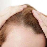 Telogenische alopecia