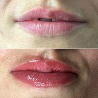 lippen voor en na eerste behandeling